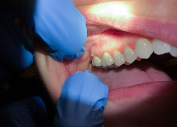 Best Emergency Root Canal Therapy in Drum Point, MD